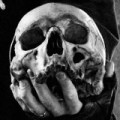 Metalsplitter - Mayhem-Knochensplitter zu verkaufen